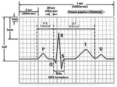 Obr. 3 Typický průběh EKG