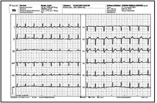 Obr. 4 Záznam 12-ti svodového EKG