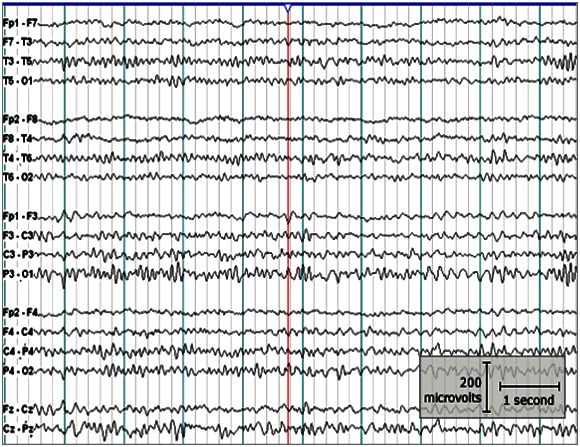 Obr. 6 Příklad 18-ti svodového EEG
