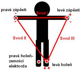 Obr. 1. Rozmístění elektrod na těle, Eithovenův trojúhelník.